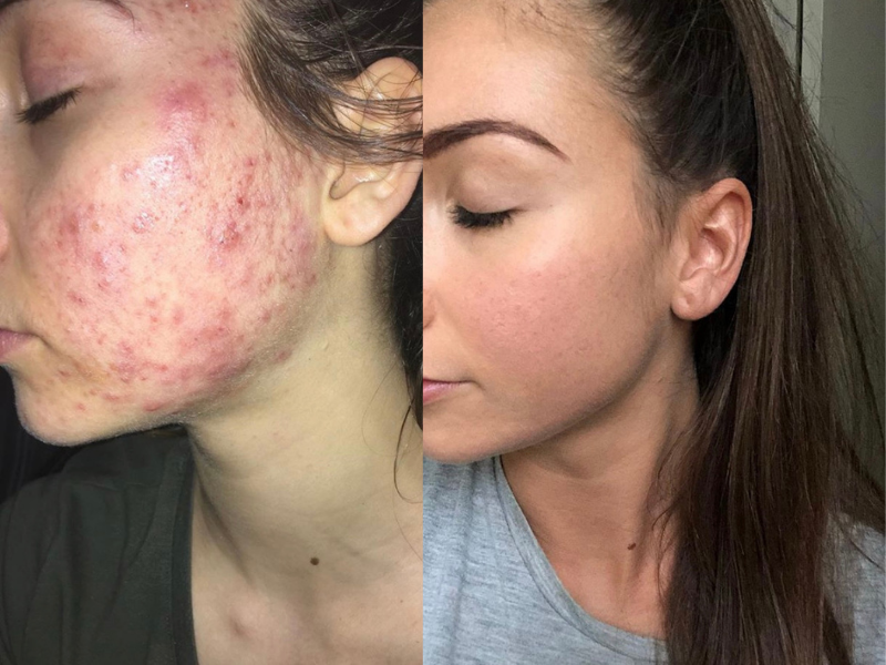 Zilch Acne Formula Before and After photo review