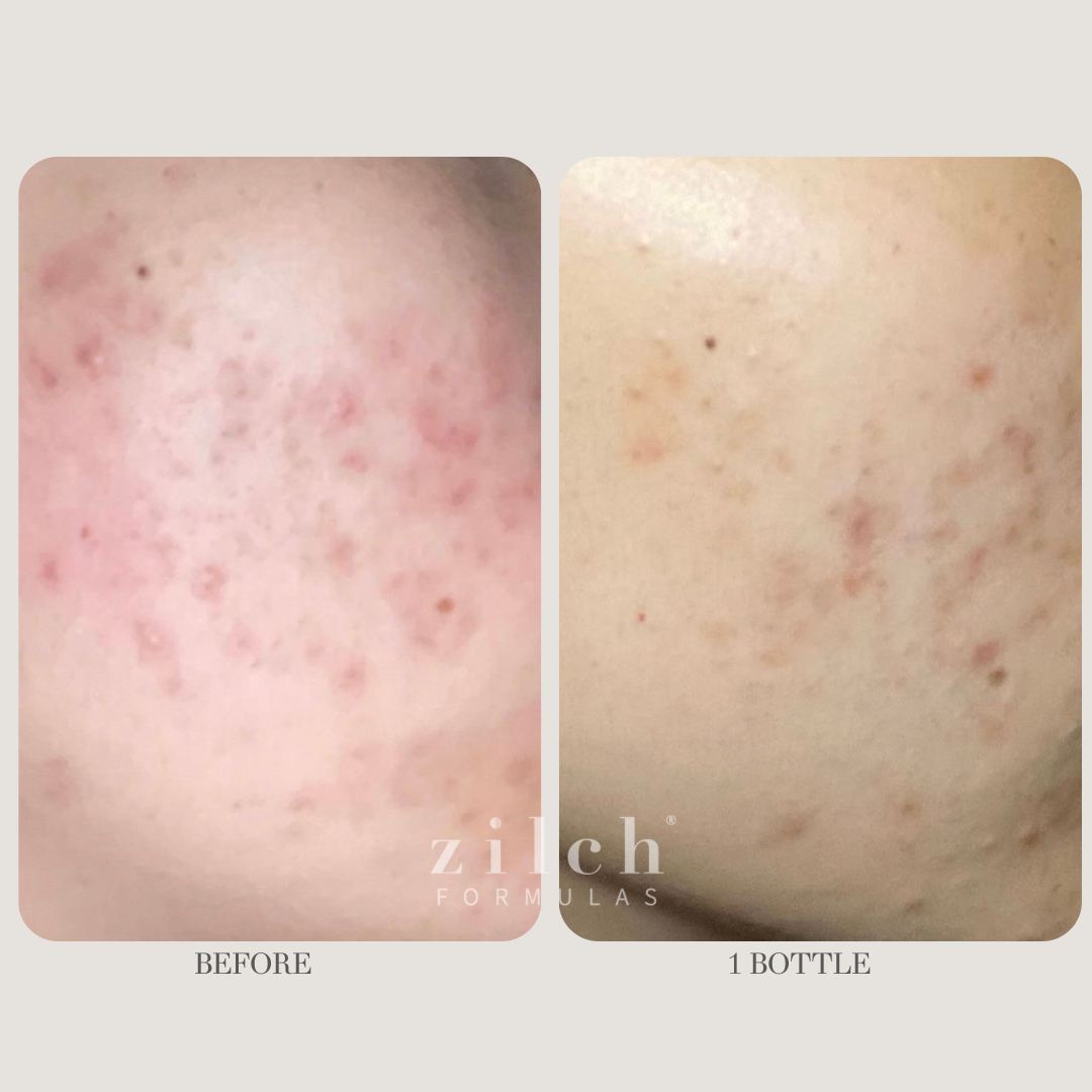 Zilch Acne Formula Before and After photo review