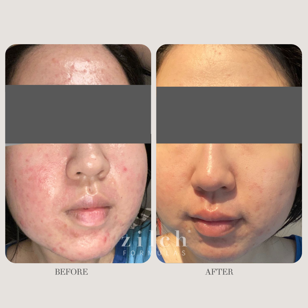 Zilch Acne Formula Before and After photo review