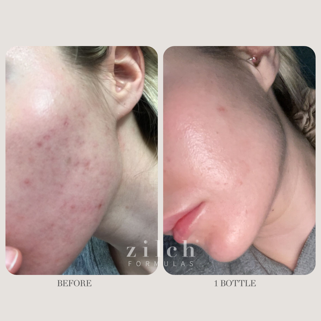 Zilch Acne Formula Before and After photo review