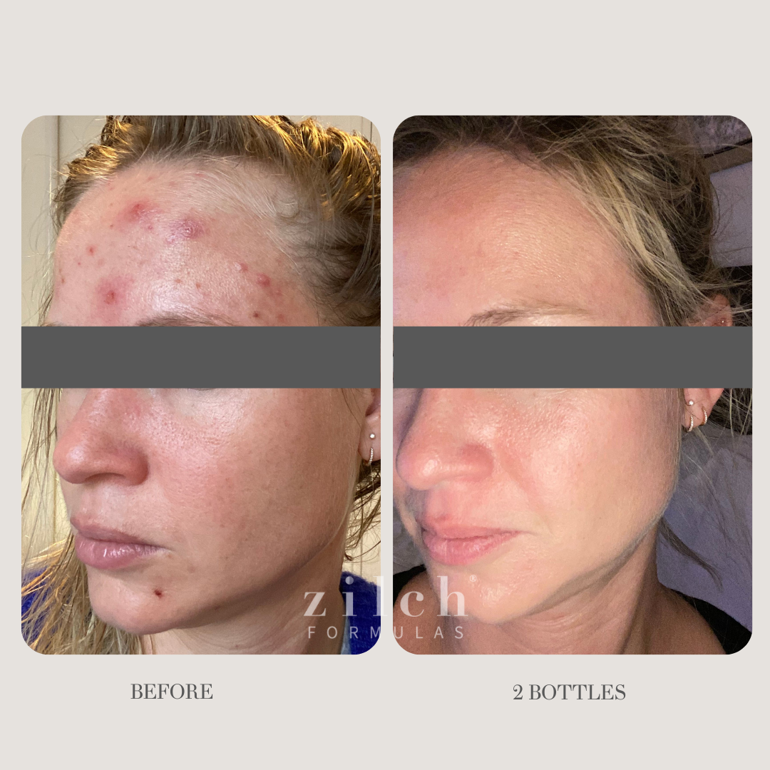Zilch Acne Formula Before and After photo review