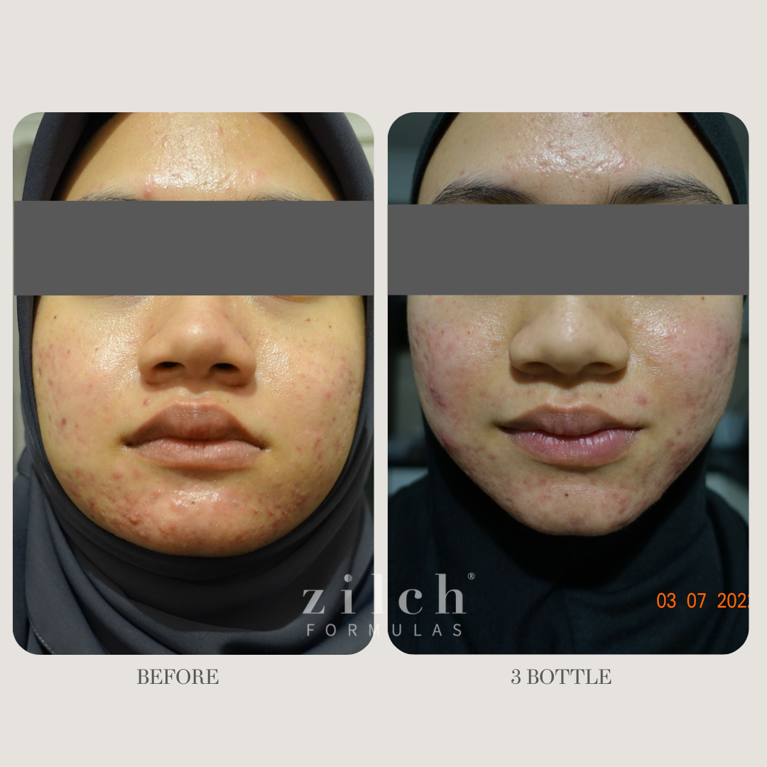 Zilch Acne Formula Before and After photo Review