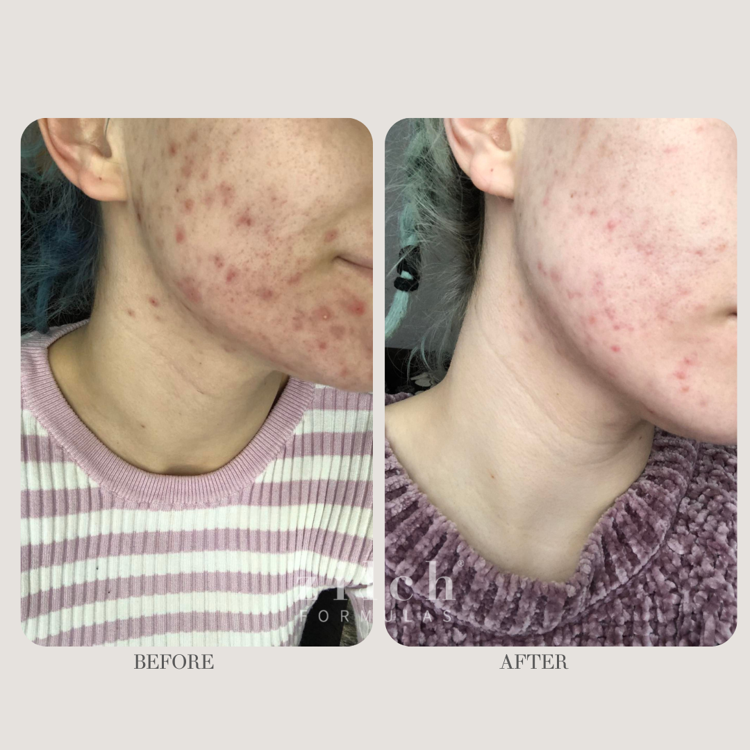 Zilch Acne Formula Before and After photo Review