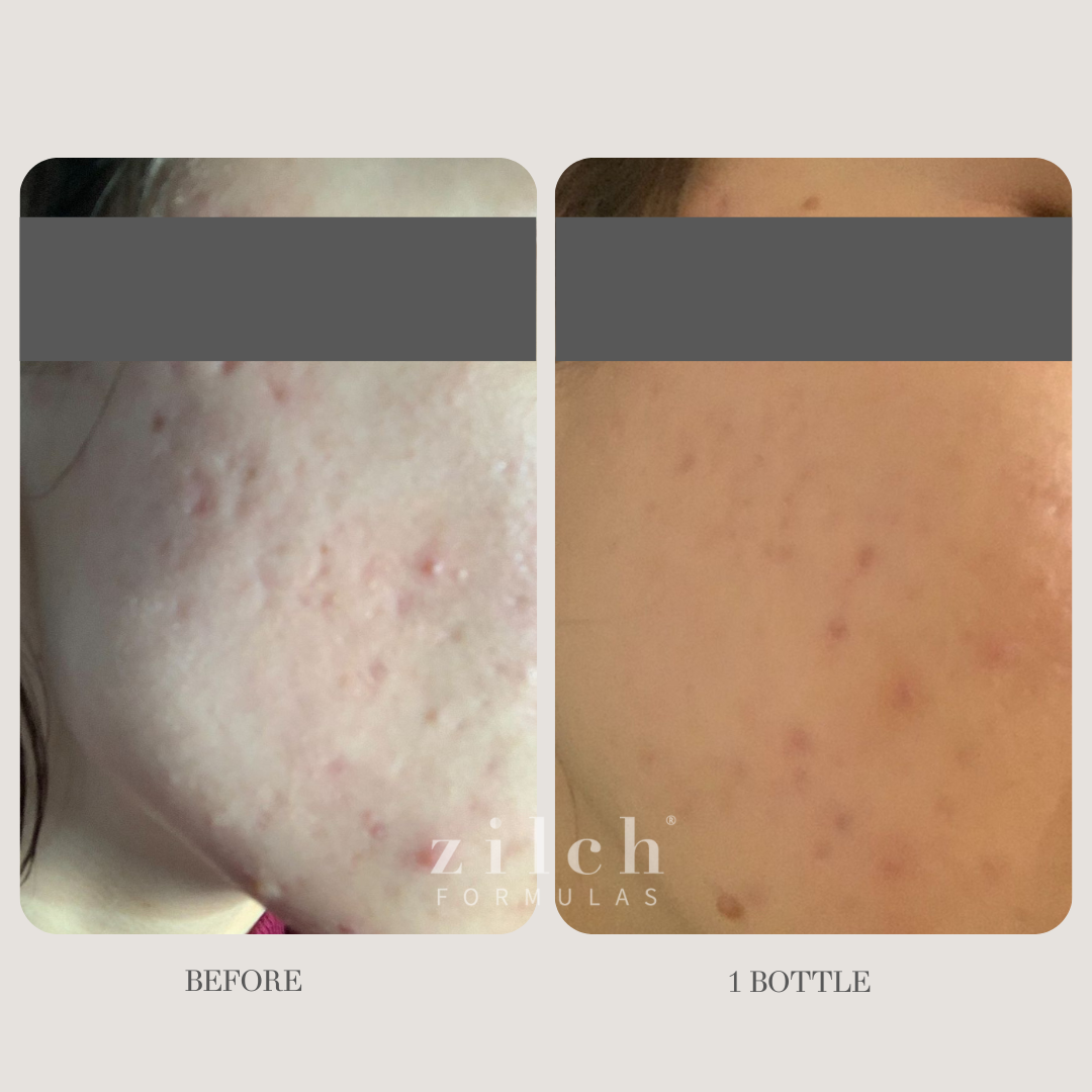 Zilch Acne Formula Before and After photo Review