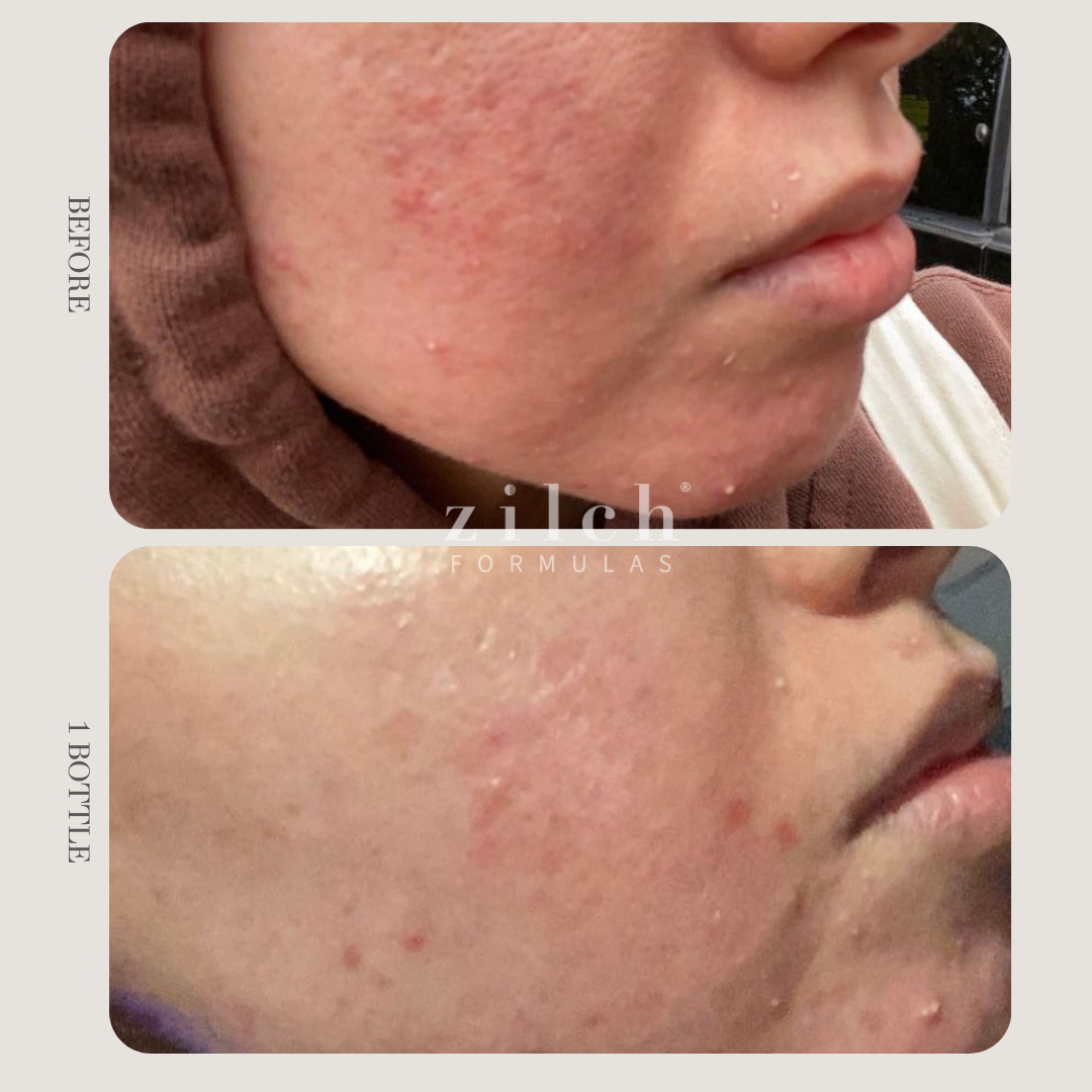 Zilch Acne Formula Before and After photo Review