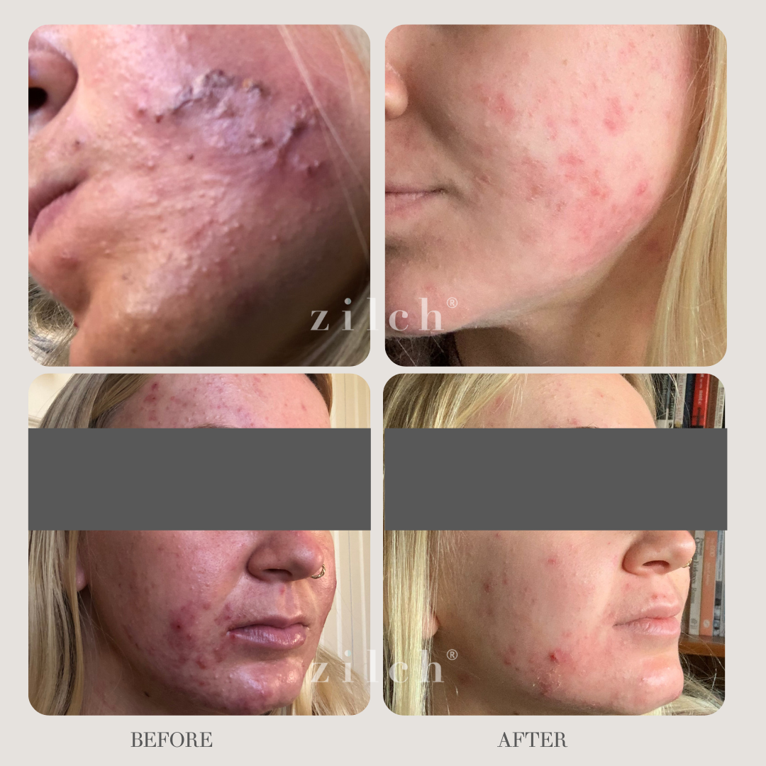 Zilch Acne Formula Before and After photo review