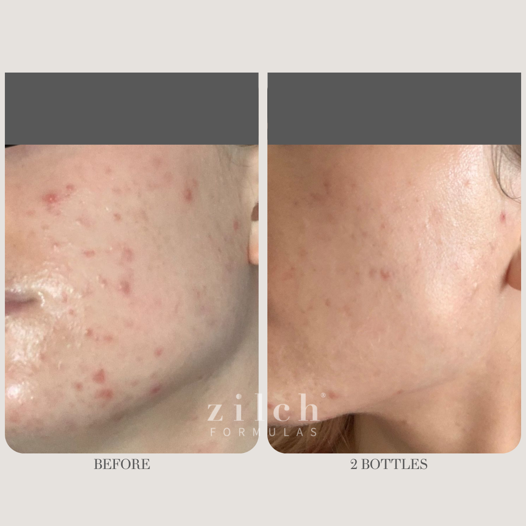 Zilch Acne Formula Before and After photo review