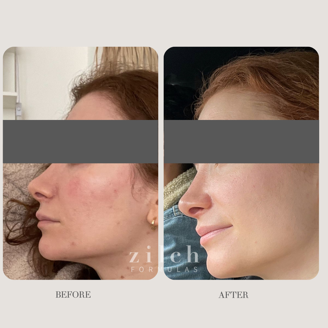 Zilch Acne Formula Before and After photo Review