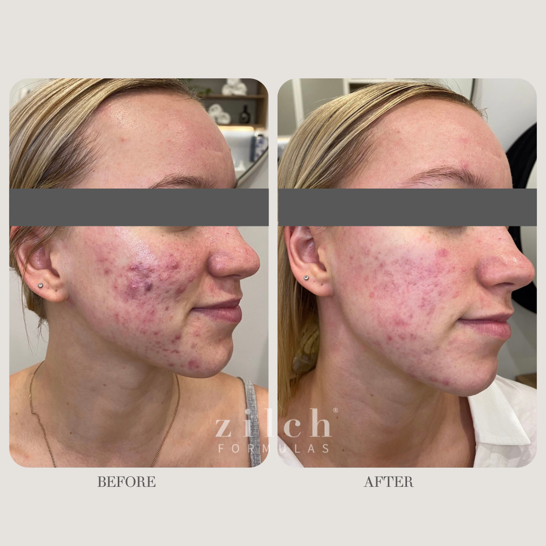 Zilch Acne Formula Before and After photo Review