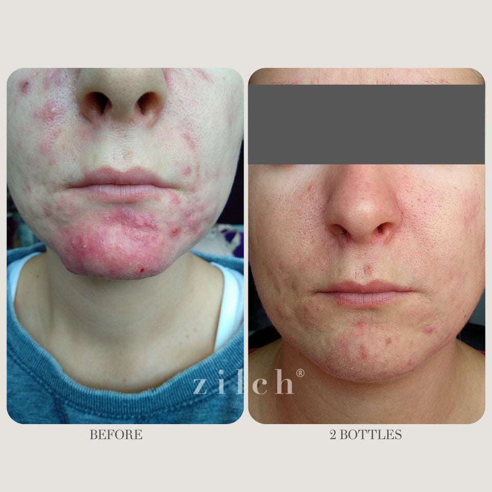 Zilch Acne Formula Before and After photo review